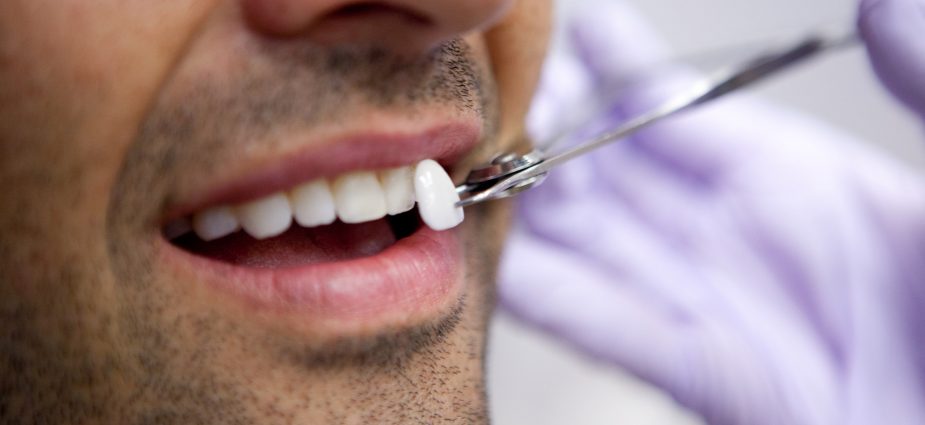 dental veneers in Turkey